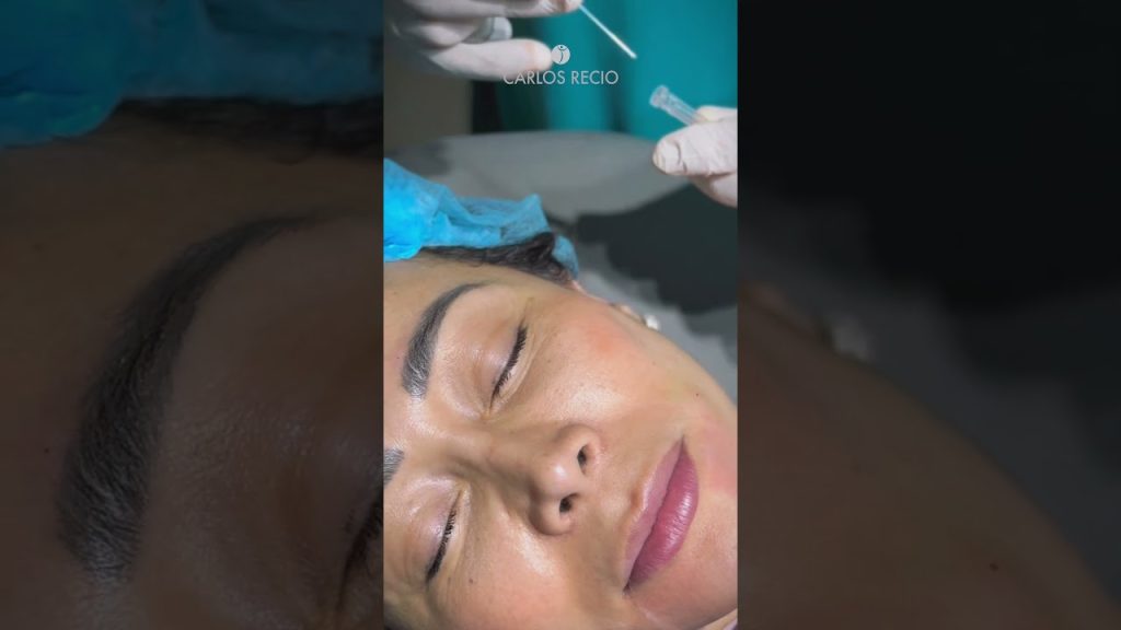 Sculptra facial: qué es este bioestimulador, cómo actúa y en qué casos está indicado Sculptra facial: qué es este bioestimulador, cómo actúa y en qué casos está indicado